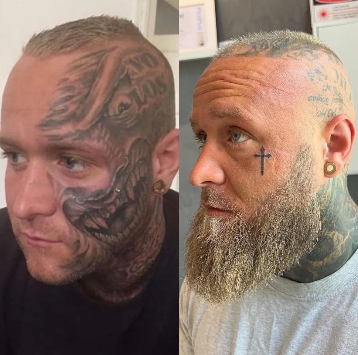 Før og efter tatoveringsfjernelse på underarm — sort skrift fjernet helt hos NUDE