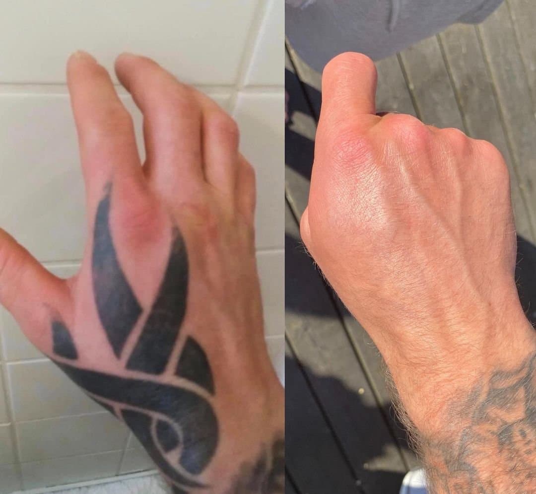 Før og efter tatoveringsfjernelse på skulder — farvet motiv nedbrudt af Picoplus-laseren