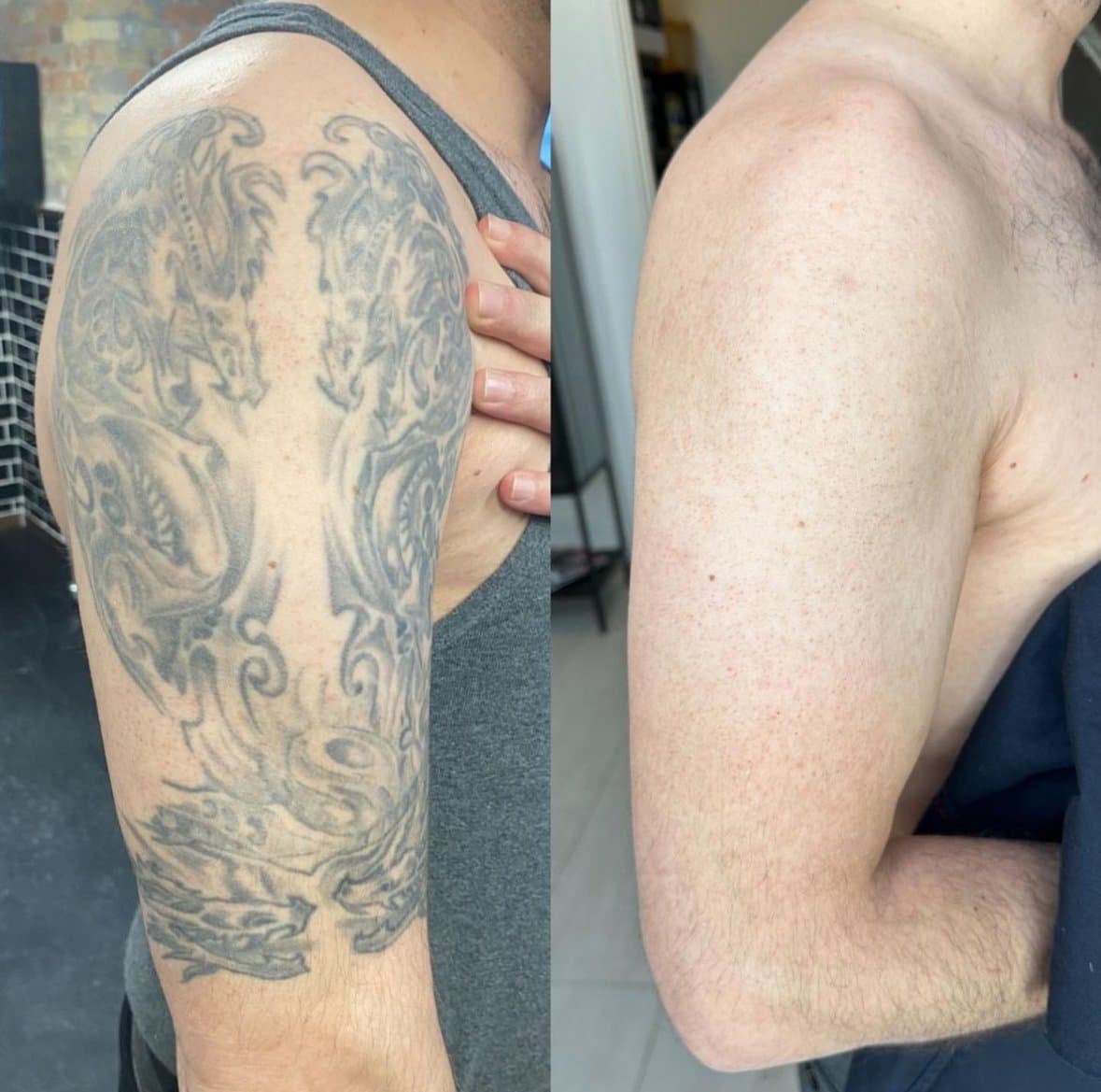 Før og efter tatoveringsfjernelse på håndled — huden som før tatoveringen