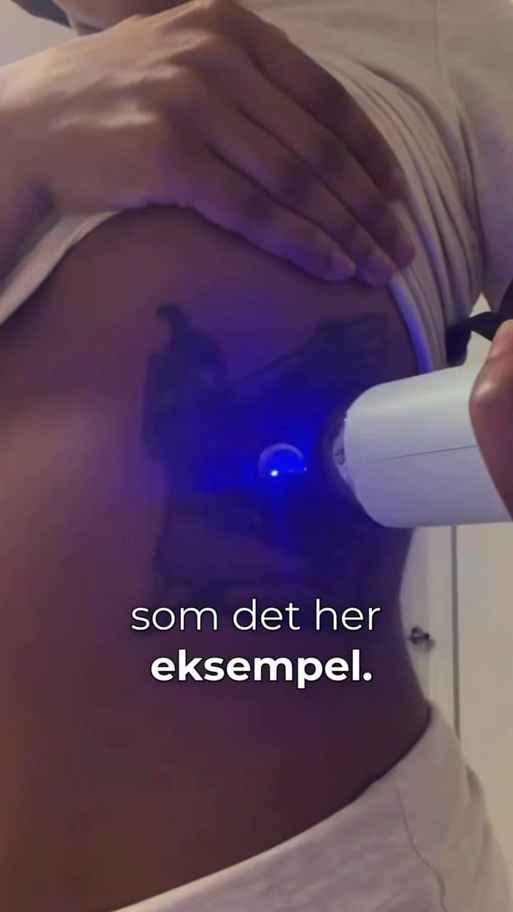 NUDE om billige håndlasere til at fjerne sin tatovering selv derhjemme