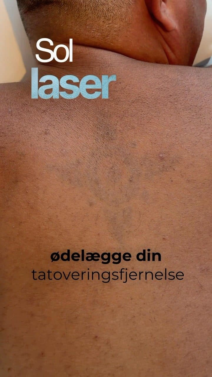 Tatoveringsfjernelse om sommeren: beskyt huden mod sol efter laserbehandling med faktor 50+