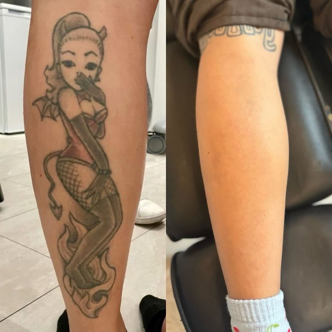 Farvet pin-up-tatovering på læggen før og efter fjernelse hos NUDE
